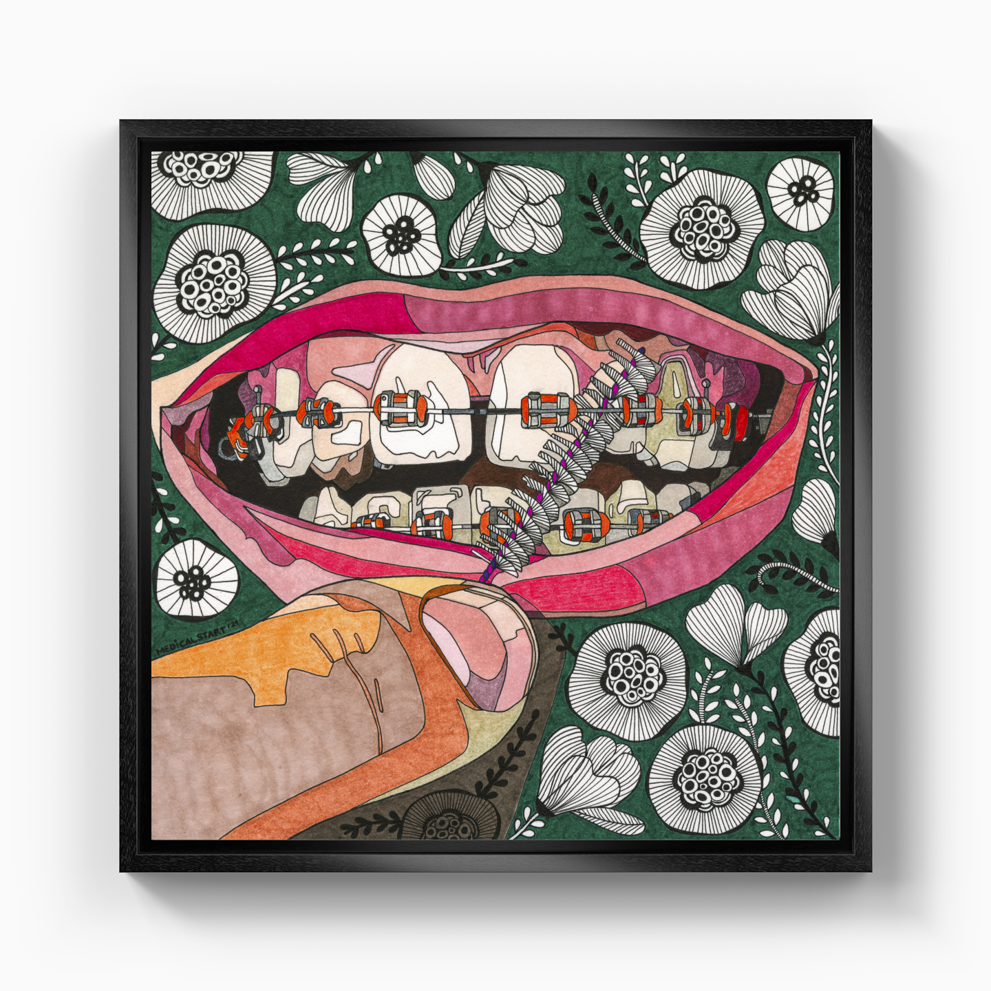 oral care in orthodontia - Canvas Print