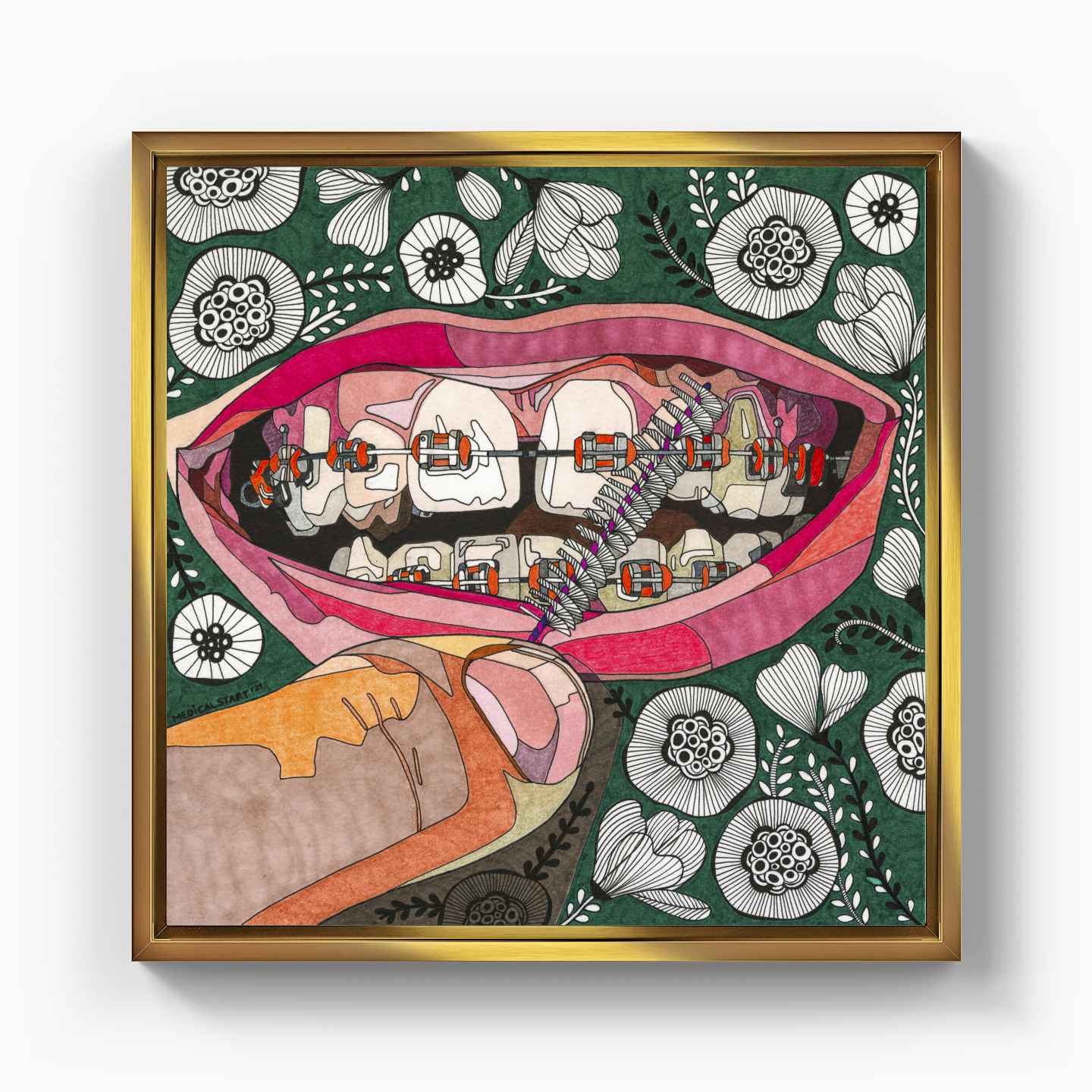 oral care in orthodontia - Canvas Print